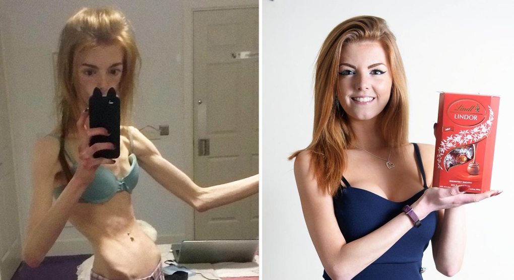 The naked Truth about Mali's eating Disorder